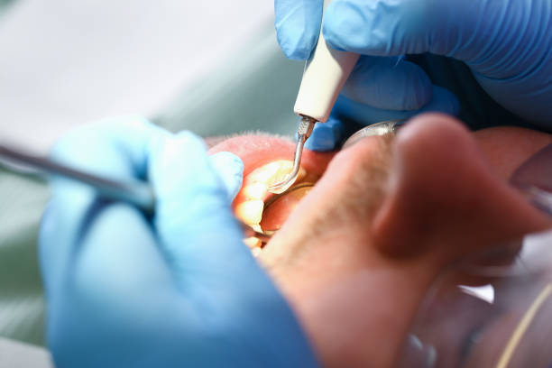 Best Emergency Root Canal Treatment in Thompsonville, PA